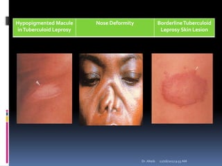 12/16/20129:55 AMDr. Alteib
Hypopigmented Macule
inTuberculoid Leprosy
Nose Deformity BorderlineTuberculoid
Leprosy Skin Lesion
 