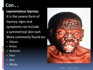 Con..
Lepromatous leprosy:
It is the severe form of
leprosy, signs and
symptoms can Include
a symmetrical skin rash
More commonly found on:
 Elbows
 Knees
 Buttocks
 Face
 Ears
 Wrists.
12/16/20129:55 AMDr. Alteib
 