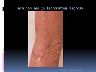 arm nodules in lepromatous leprosy
12/16/20129:55 AMDr. Alteib
 