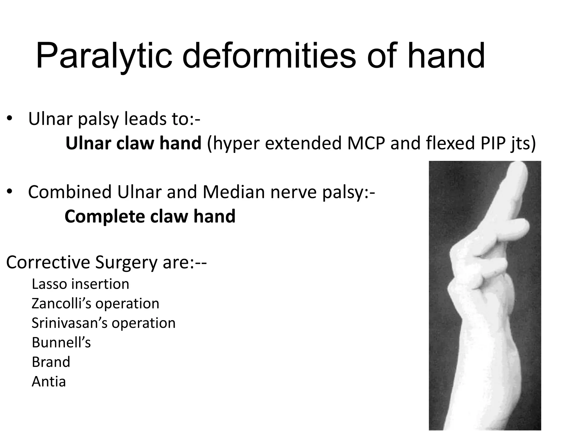 Paralytic deformities of hand
• Ulnar palsy leads to:-
Ulnar claw hand (hyper extended MCP and flexed PIP jts)
• Combined Ulnar and Median nerve palsy:-
Complete claw hand
Corrective Surgery are:--
Lasso insertion
Zancolli’s operation
Srinivasan’s operation
Bunnell’s
Brand
Antia
 