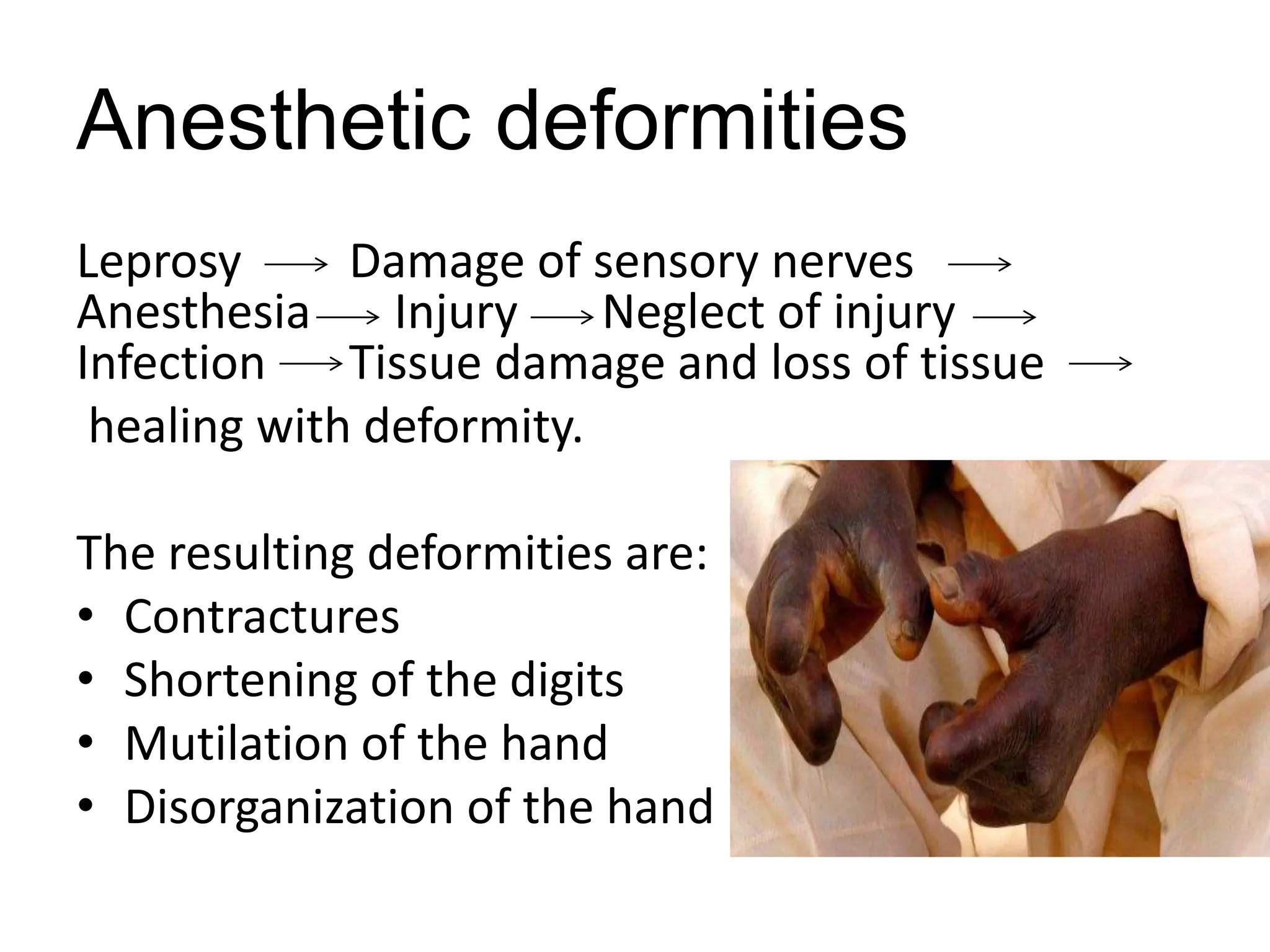 Anesthetic deformities
Leprosy Damage of sensory nerves
Anesthesia Injury Neglect of injury
Infection Tissue damage and loss of tissue
healing with deformity.
The resulting deformities are:
• Contractures
• Shortening of the digits
• Mutilation of the hand
• Disorganization of the hand
 