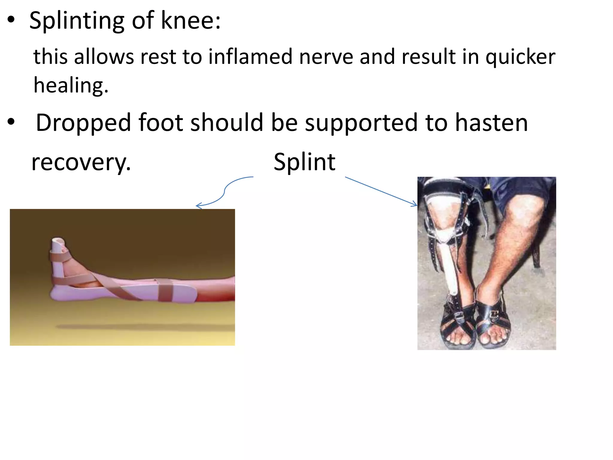 • Splinting of knee:
this allows rest to inflamed nerve and result in quicker
healing.
• Dropped foot should be supported to hasten
recovery. Splint
 