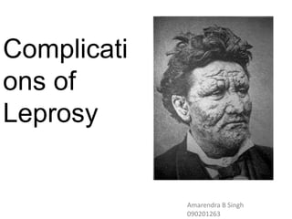 Complicati
ons of
Leprosy
Amarendra B Singh
090201263
 