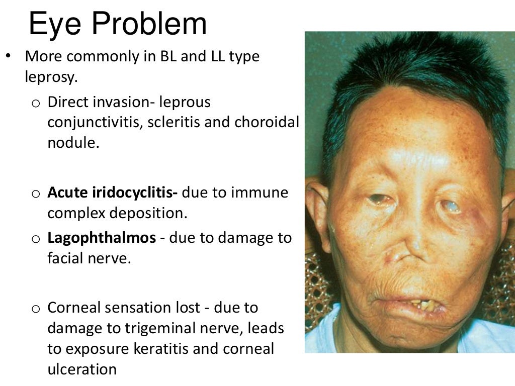 Complications of leprosy