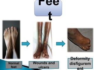 Fee
t
Normal
feet
Wounds and
ulcers
Deformity
disfigurem
ent
 