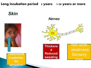Long incubation period 5 years 1-20 years or more
Skin
Nerves
Discoloure
d patches,
No
sensation
Thickene
d
Reduced
sweating
Not work
weakness
Sensory
loss
 
