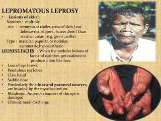 LEPROMATOUS LEPROSY
• Lesions of skin :
Number : multiple
site : common at cooler areas of skin ( ear
lobes,wrist, elbows , knees ,feet ) than
warmer areas ( e.g. groin ,axilla).
Type : macular, papular, or nodular,
symmetric,hypoaesthetic
LEONINE FACIES - When the nodular lesions of
face and earlobes get coalesce to
produce a lion like face.
• Loss of eye brows
• Pendulous ear lobes
• Claw hand
• Saddle nose
• Particularly the ulnar and paroneal nearves
are invaded by the mycobacterium.
• Blindness : Anterior chamber of the eye is
damaged
• Chronic nasal discharge
 