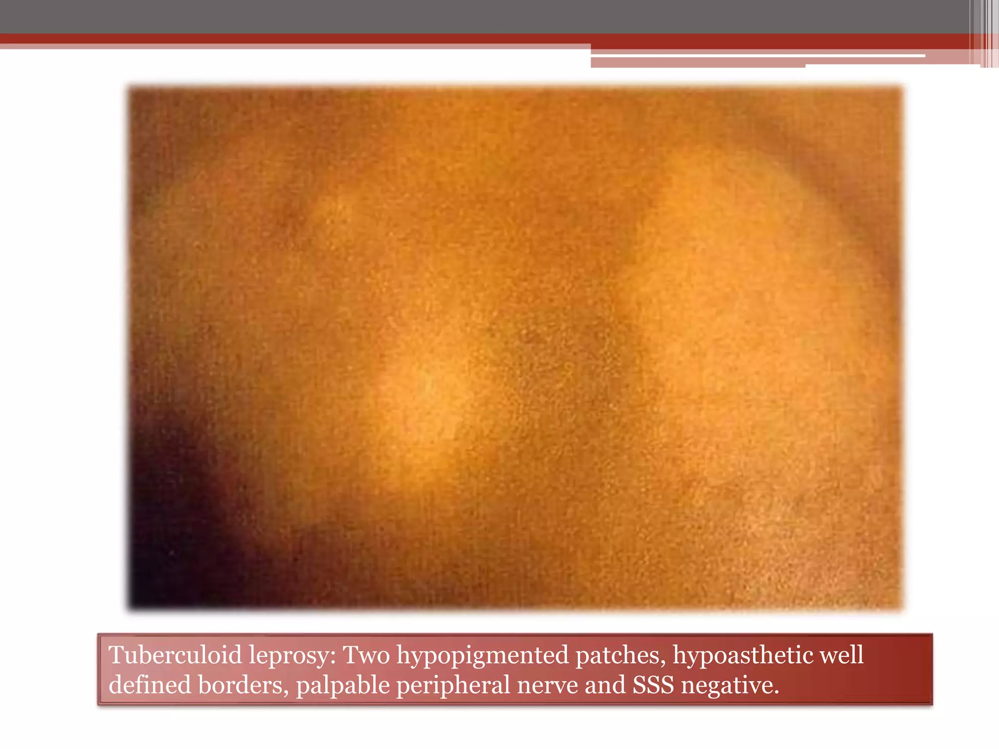 Leprosy ( hansen’s disease ) | PPTX