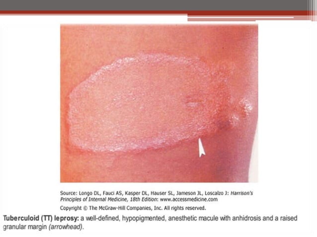 Leprosy ( hansen’s disease ) | PPTX