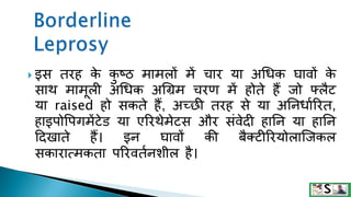  इस तरह क
े क
ु ष्ठ मामलों में चार या अगधक घावों क
े
साथ मामूली अगधक अगिम चरण में होते हैं जो फ्लैट
या raised हो सकते हैं, अच्छ तरह से या अननधागररत,
हाइपोवपगमेंटेि या एररथेमेटस और संवेदी हानन या हानन
टदखाते हैं। इन घावों की बैक्टीररयोलाजजकल
सकारात्मकता पररवतगनिील है।
 