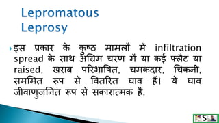  इस प्रकार क
े क
ु ष्ठ मामलों में infiltration
spread क
े साथ अगिम चरण में या कई फ्लैट या
raised, खराब पररभावषत, चमकदार, गचकनी,
समशमत रूप से ववतररत घाव हैं। ये घाव
जीवाणुजननत रूप से सकारात्मक हैं,
 