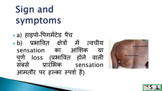  a) हाइपो-वपगमेंटेि पैच
 b) प्रभाववत क्षेत्रों में त्वचीय
sensation का आंशिक या
पूणग loss (प्रभाववत होने वाली
सबसे प्रारंशभक sensation
आमतौर पर हल्का स्पिग है)
 