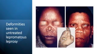 Deformities
seen in
untreated
lepromatous
leprosy
 
