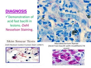 DIAGNOSIS
Demonstration of
acid fast bacilli in
lesions.-Ziehl
Nesselson Staining.
 