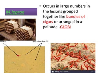 M.leprae
• Occurs in large numbers in
the lesions grouped
together like bundles of
cigars or arranged in a
palisade.-GLOBI
 