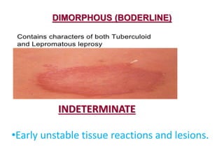 DIMORPHOUS (BODERLINE)
INDETERMINATE
•Early unstable tissue reactions and lesions.
 