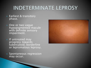  Earliest & transitory
phase.
 One or two vague
hypopigmented macule
with definite sensory
impairment.
 If untreated may
progress towards
tuberculoid, borderline
or lepromatous leprosy.
 Spontaneous regression
may occur.
 