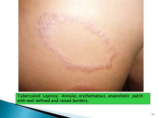 Tuberculoid Leprosy: Annular, erythematous, anaesthetic patch
with well defined and raised borders.
14
 