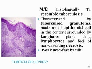 TUBERCULOID LEPROSY
M/E: Histologically TT
resemble tuberculosis.
 Characterized by
tuberculoid granuloma,
made up of epitheloid cell
in the center surrounded by
Langhans giant cells,
lymphocytes and foci of
non-caseating necrosis.
 Weak acid-fast bacilli.
16
 