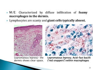  M/E: Characterized by diffuse infiltration of foamy
macrophages in the dermis.
 Lymphocytes are scanty and giant cells typically absent.
22
Lepromatous leprosy. Acid-fast bacilli
(“red snappers”) within macrophages
Lepromatous leprosy- the
dermis shows clear space.
 
