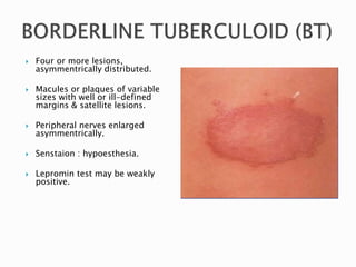  Four or more lesions,
asymmentrically distributed.
 Macules or plaques of variable
sizes with well or ill-defined
margins & satellite lesions.
 Peripheral nerves enlarged
asymmentrically.
 Senstaion : hypoesthesia.
 Lepromin test may be weakly
positive.
 