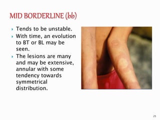  Tends to be unstable.
 With time, an evolution
to BT or BL may be
seen.
 The lesions are many
and may be extensive,
annular with some
tendency towards
symmetrical
distribution.
25
 