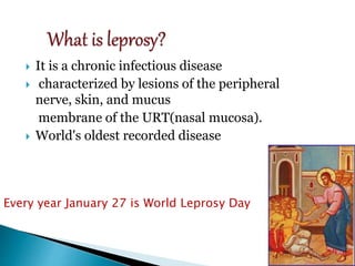  It is a chronic infectious disease
 characterized by lesions of the peripheral
nerve, skin, and mucus
membrane of the URT(nasal mucosa).
 World's oldest recorded disease
Every year January 27 is World Leprosy Day
3
 