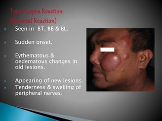  Seen in BT, BB & BL.
 Sudden onset.
 Eythematous &
oedematous changes in
old lesions.
 Appearing of new lesions.
 Tenderness & swelling of
peripheral nerves.
 