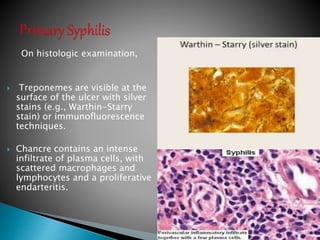 On histologic examination,
 Treponemes are visible at the
surface of the ulcer with silver
stains (e.g., Warthin-Starry
stain) or immunofluorescence
techniques.
 Chancre contains an intense
infiltrate of plasma cells, with
scattered macrophages and
lymphocytes and a proliferative
endarteritis.
40
 