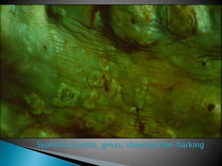 Syphilitic aortitis, gross, showing tree-barking
 