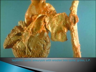 Syphilitic aortic aneurysm with erosion into spine, gross, L.P.
 
