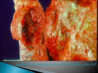 Syphilitic aortic aneurysm with erosion into spine, gross, H.P.
 
