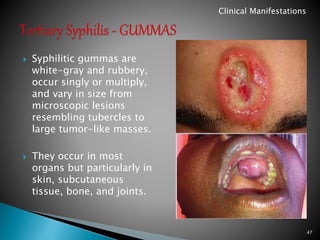  Syphilitic gummas are
white-gray and rubbery,
occur singly or multiply,
and vary in size from
microscopic lesions
resembling tubercles to
large tumor-like masses.
 They occur in most
organs but particularly in
skin, subcutaneous
tissue, bone, and joints.
47
Clinical Manifestations
 
