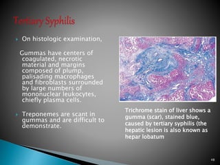  On histologic examination,
Gummas have centers of
coagulated, necrotic
material and margins
composed of plump,
palisading macrophages
and fibroblasts surrounded
by large numbers of
mononuclear leukocytes,
chiefly plasma cells.
 Treponemes are scant in
gummas and are difficult to
demonstrate.
48
Trichrome stain of liver shows a
gumma (scar), stained blue,
caused by tertiary syphilis (the
hepatic lesion is also known as
hepar lobatum
 