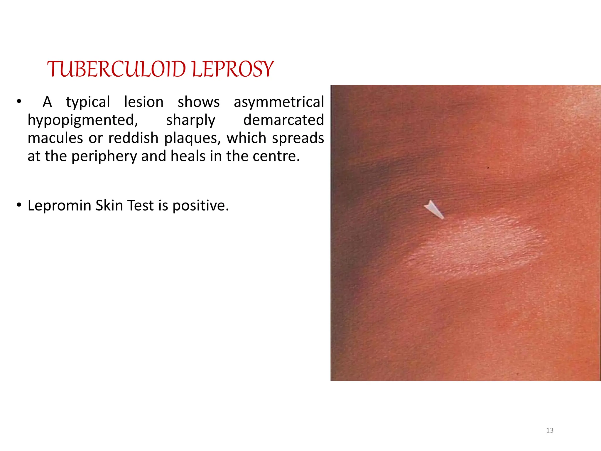 leprosysyphilis - LEPROSY & SYPHILIS.pptx