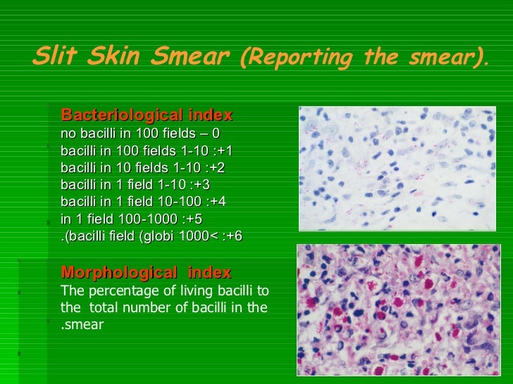 Leprosy for undergraduate medical students