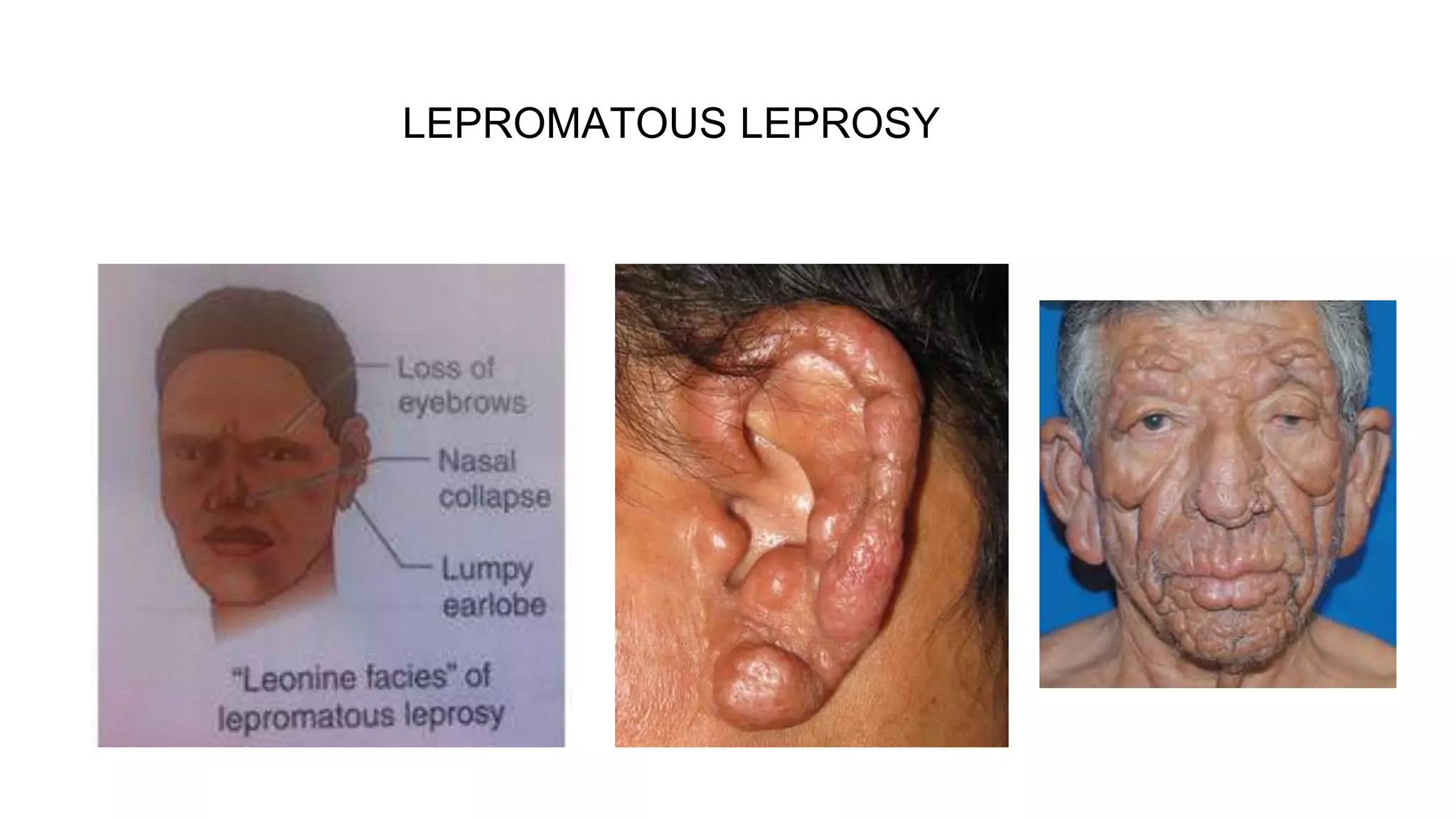 Leprosy UG Class pptx leprosy-ug-class-pptx