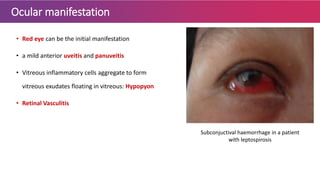 Ocular manifestation
• Red eye can be the initial manifestation
• a mild anterior uveitis and panuveitis
• Vitreous inflammatory cells aggregate to form
vitreous exudates floating in vitreous: Hypopyon
• Retinal Vasculitis
Subconjuctival haemorrhage in a patient
with leptospirosis
 