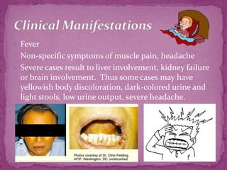 FeverNon-specific symptoms of muscle pain, headacheSevere cases result to liver involvement, kidney failure or brain involvement.  Thus some cases may have yellowish body discoloration, dark-colored urine and light stools, low urine output, severe headache.Clinical Manifestations