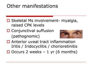 Other manifestations

 Skeletal Ms involvement- myalgia,
  raised CPK levels
 Conjunctival suffusion
  (pathognomic)
 Anterior uveal tract inflammation
  Iritis / Iridocyclitis / chorioretinitis
 Occurs 2 weeks – 1 yr (6 months)
 