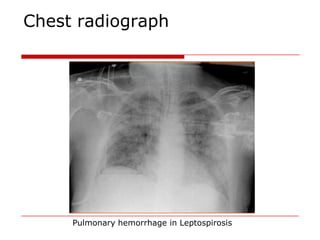 Chest radiograph




     Pulmonary hemorrhage in Leptospirosis
 