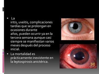  La

iritis, uveitis, complicaciones
tardías que se prolongan en
ocasiones durante
años, pueden ocurrir ya en la
tercera semana aunque casi
siempre se manifiestan varios
meses después del proceso
inicial.
 La mortalidad es
prácticamente inexistente en
la leptospirosis anictérica.

 