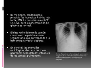  Rx meningea, predominan al

principio los leucocitos PMN y, más
tarde, MN. La proteínas en el LCR
se eleva, pero la concentración de
glucosa es normal.

 El dato radiológico más común

consiste en un patrón alveolar
segmentario, que corresponde a la
hemorragia alveolar dispersa.

 En general, las anomalías

radiológicas afectan a las zonas
periféricas de los lóbulos inferiores
de los campos pulmonares.

Radiografía de tórax 12 horas después que muestra
progresión de los infiltrados alveolares bilaterales
predominantemente en campos medios e
inferiores.

 