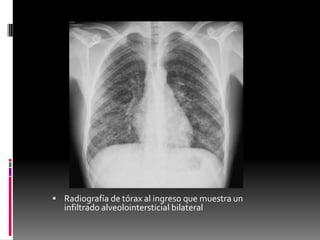  Radiografía de tórax al ingreso que muestra un

infiltrado alveolointersticial bilateral

 