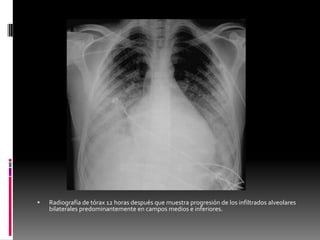 

Radiografía de tórax 12 horas después que muestra progresión de los infiltrados alveolares
bilaterales predominantemente en campos medios e inferiores.

 