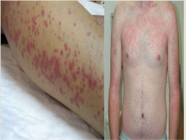 Leptospirosis : An Overview