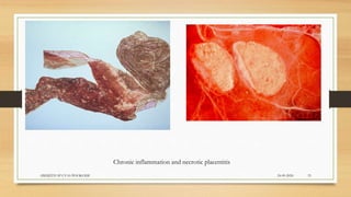 Chronic inflammation and necrotic placentitis
24-09-2020ABHIJITH SP CVAS POOKODE 33
 