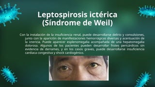 Leptospirosis ictérica
(Síndrome de Weil)
Con la instalación de la insuficiencia renal, puede desarrollarse delirio y convulsiones,
junto con la aparición de manifestaciones hemorrágicas diversas y acentuación de
la ictericia. Puede aparecer esplenomegalia acompañada de una hepatomegalia
dolorosa. Algunos de los pacientes pueden desarrollar frotes pericárdicos sin
evidencia de derrames, y en los casos graves, puede desarrollarse insuficiencia
cardiaca congestiva y shock cardiogénico.
 