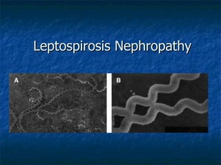 Leptospirosis Nephropathy 
