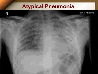 Atypical Pneumonia
 